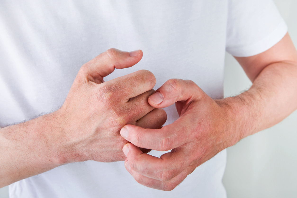 Man scratches or shows hands with dry, cracked skin on white backgrounds. Problem with many people - eczema on hand, allergies or dry skin. Health care concept. Close up.